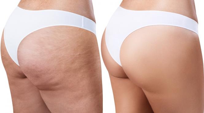 solutia naturala scapi celulita