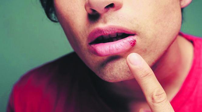 herpes tratament natural remedii casnice