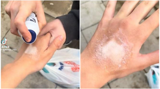 nou pericol tiktok adolescenti mutilati viata dupa raspuns provocarea deodorantului
