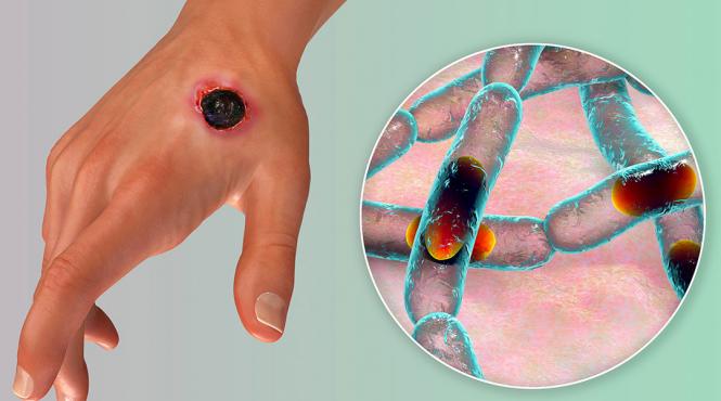 antrax boala tratament simptome coma