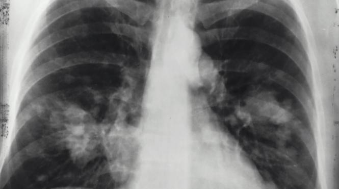 ingrijire pulmonara simptome cancer harta cabinete medicale romania
