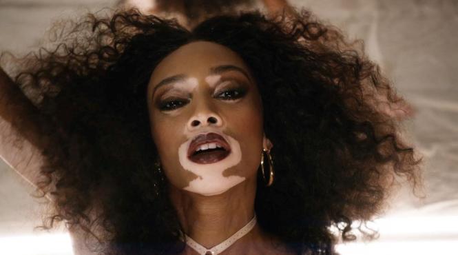 pfizer litfulo vitiligo tratament oral rezultate