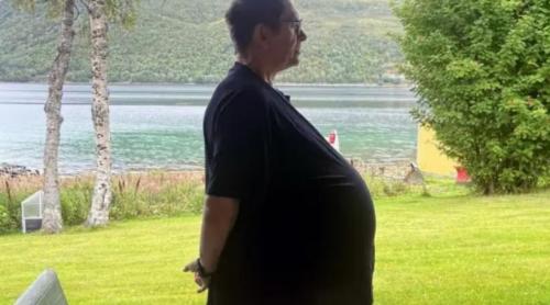 For 12 years, doctors told a Norwegian man he was fat and gave him Ozempic. He actually suffered from a tumor weighing 27 kg in his stomach 