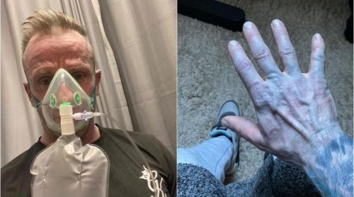 Un bărbat s a dus la Urgențe cu pielea albastră. Panicați, medicii i au pus masca de oxigen, apoi și au dat seama ce avea, de fapt