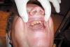 Proteza scheletată, alternativă la implanturile dentare 1513982