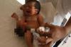 CAZ ULUITOR într-un spital din India: O fetiţă s-a născut cu un al doilea cap ataşat de stomac! (VIDEO) 18482670