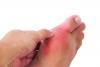 Dr. Magda Pârvu: Atacul bolilor reumatismale inflamatorii începe la degete, la articulaţiile mici 18590828