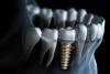Dr. Anca Vereanu, despre „Dinți într-o zi” și industria implanturilor 18666636
