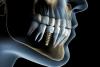 Dr. Anca Vereanu, despre „Dinți într-o zi” și industria implanturilor 18666637