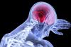 Accidentele vasculare cerebrale trecătoare anunţă un AVC masiv în creier 18711703