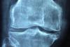 Osteoporoza e o pierdere de substanţă osoasă cu fragilizarea oaselor 18712473