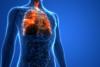 Tusea seacă are origini pulmonare doar în 60% din cazuri 18723348